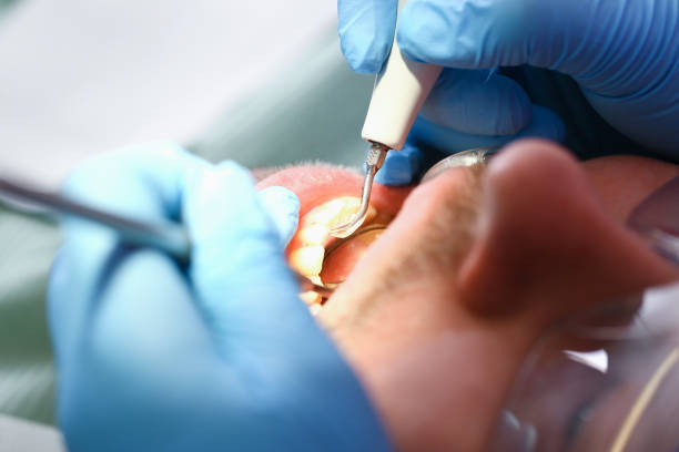 Best Emergency Wisdom Teeth Removal in Countryside, VA
